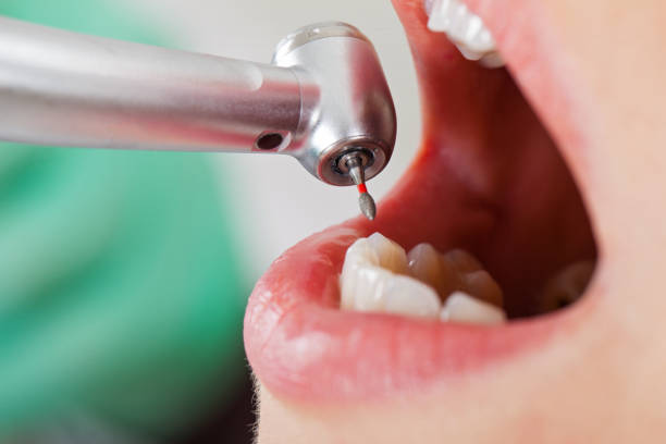 Best Emergency Wisdom Tooth Extraction in Raymondville, TX